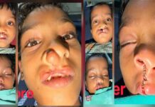 चिरायु योजना से जन्मजात समस्या से मिली राहत, तीन बच्चों के चेहरों पर लौटी मुस्कान